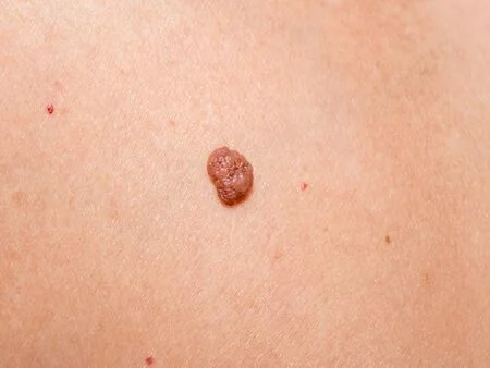 Kératoses Peau : Étiquettes, Causes et Solutions Naturelles 1 kératoses ce que vous devez savoir sur les étiquettes de peau 1