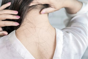 Les meilleures options de traitement de la perte de cheveux à essayer