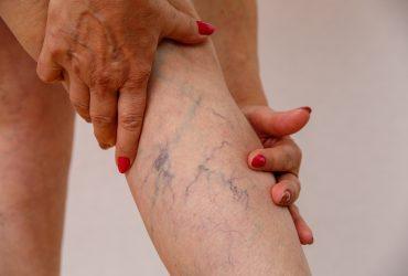 Les meilleurs moyens de traiter les varices