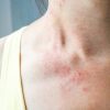young woman has skin rash itch on neck