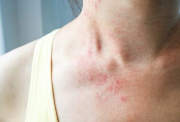 Polyplex : solution pour les problèmes de peau chroniques