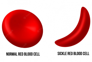 la drépanocytose – Ce que vous devez savoir