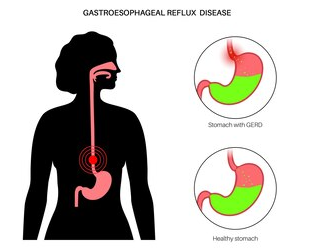 Comment éviter le reflux acide Versusajouté de douleur thoracique