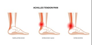 troubles du tendon