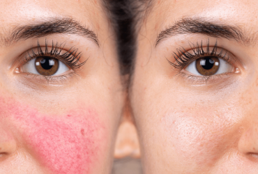 La cure contre la rosacée : explication et application