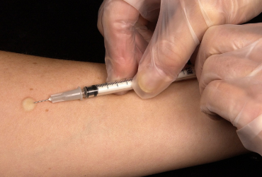 Comment savoir si vous avez la tuberculose