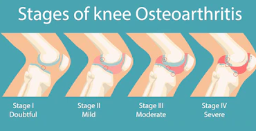 Les symptômes de l’arthrose du genou – Guide utile !