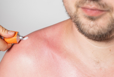Coup de soleil : Ce que vous devez savoir