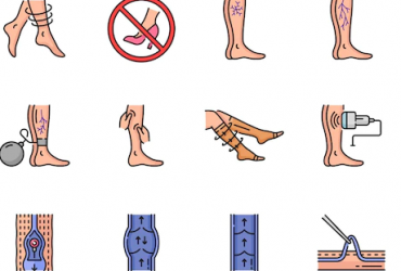 Quels sont les premiers signes d’une phlébite ?