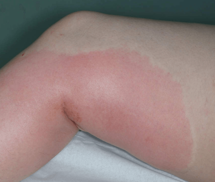 Érysipèle : Symptômes, Causes et Prévention Naturelle : Guide 1 l'érysipèle