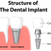 implants dentaires