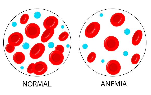Le nombre normal de globules rouges 1 globules rouges