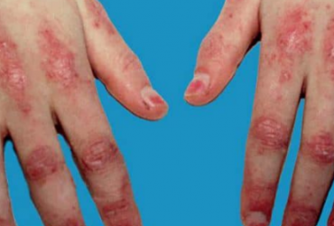Comment obtenir un traitement rapide de la dermatomyosite