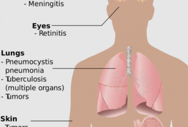 Comment savoir si vous souffrez d’une pneumonie ?