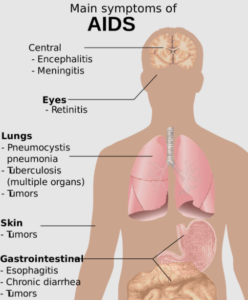 Comment savoir si vous souffrez d'une pneumonie ? 1 pneumonie