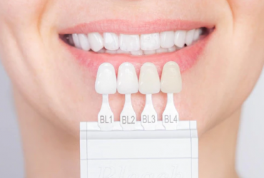 Comment obtenir une facette dentaire