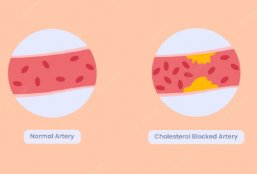 Le mauvais type de cholestérol 