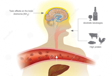 Ce qu’il faut savoir sur L’Encéphalopathie Hépatique