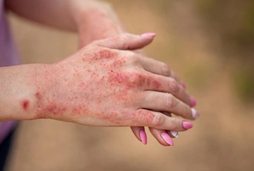 Quels sont les symptômes de la dermatite ?