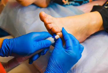 Comment traiter les mycoses des ongles
